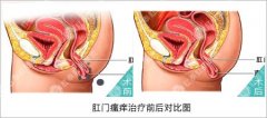 喀什睾丸炎怎么回事？